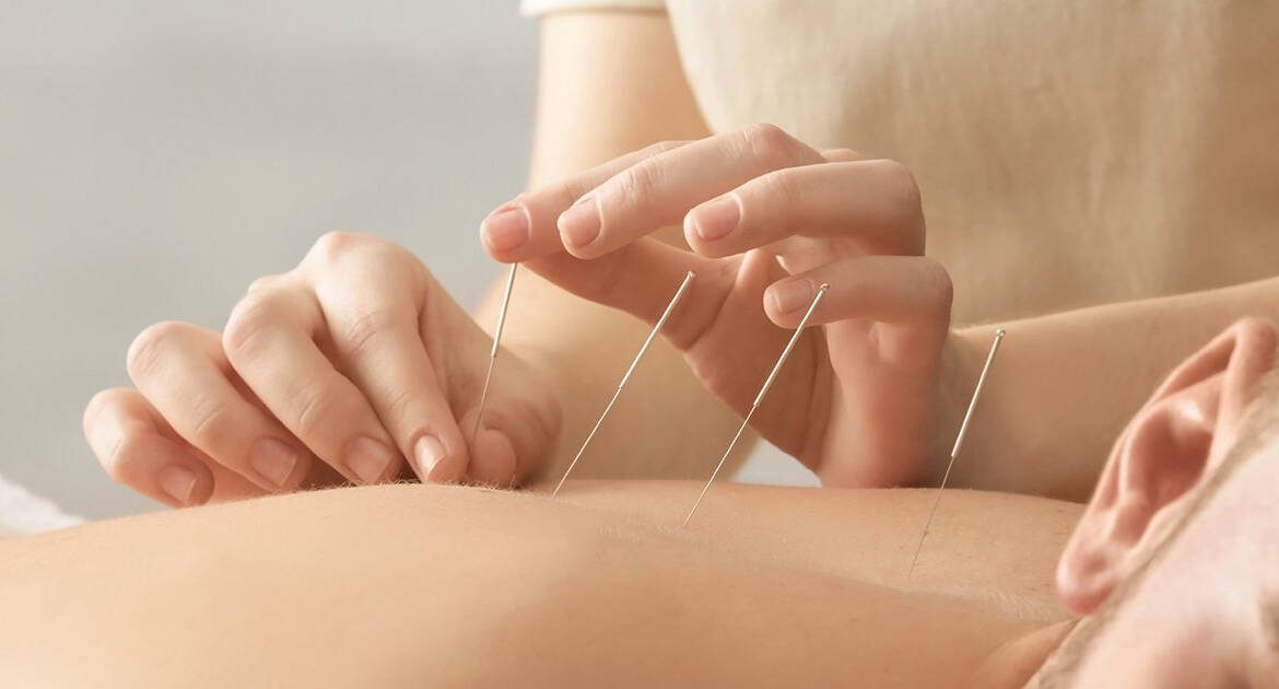 La acupuntura es un método eficaz y rentable para el dolor de espalda