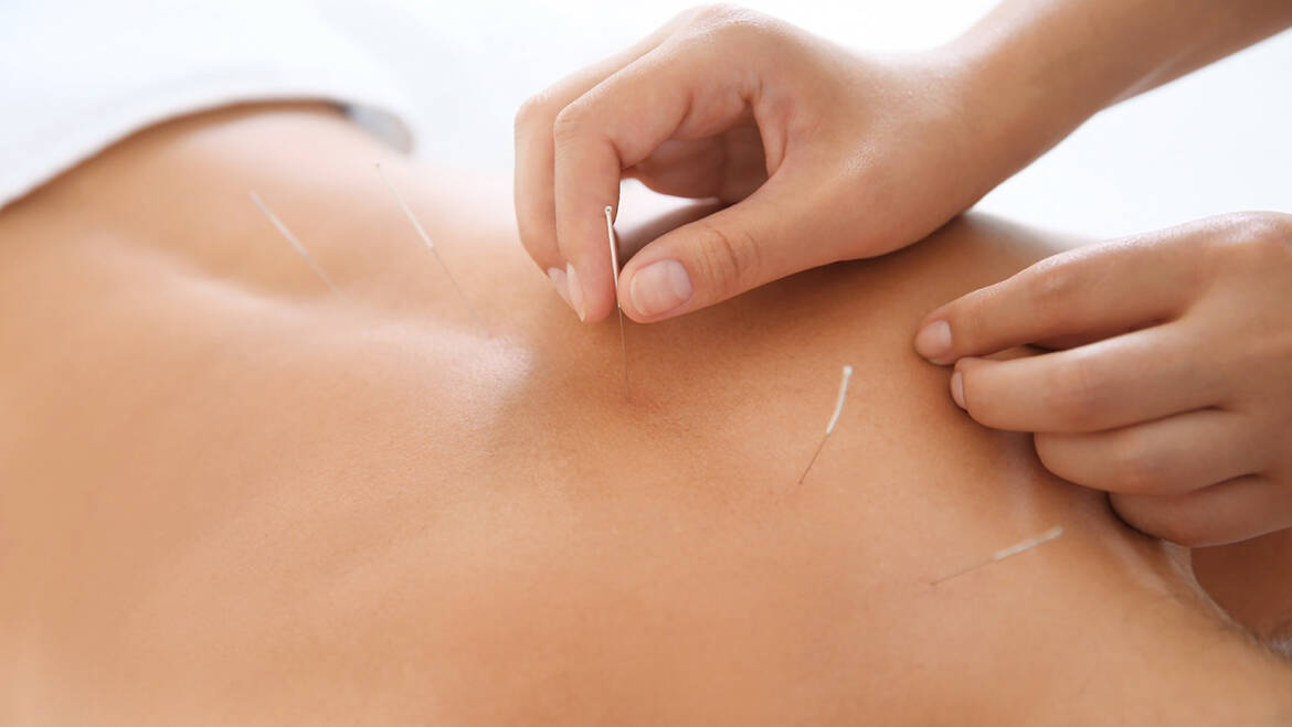 Acupuntura