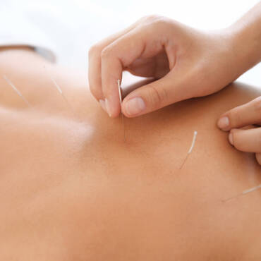 Acupuntura