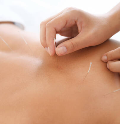 Acupuntura